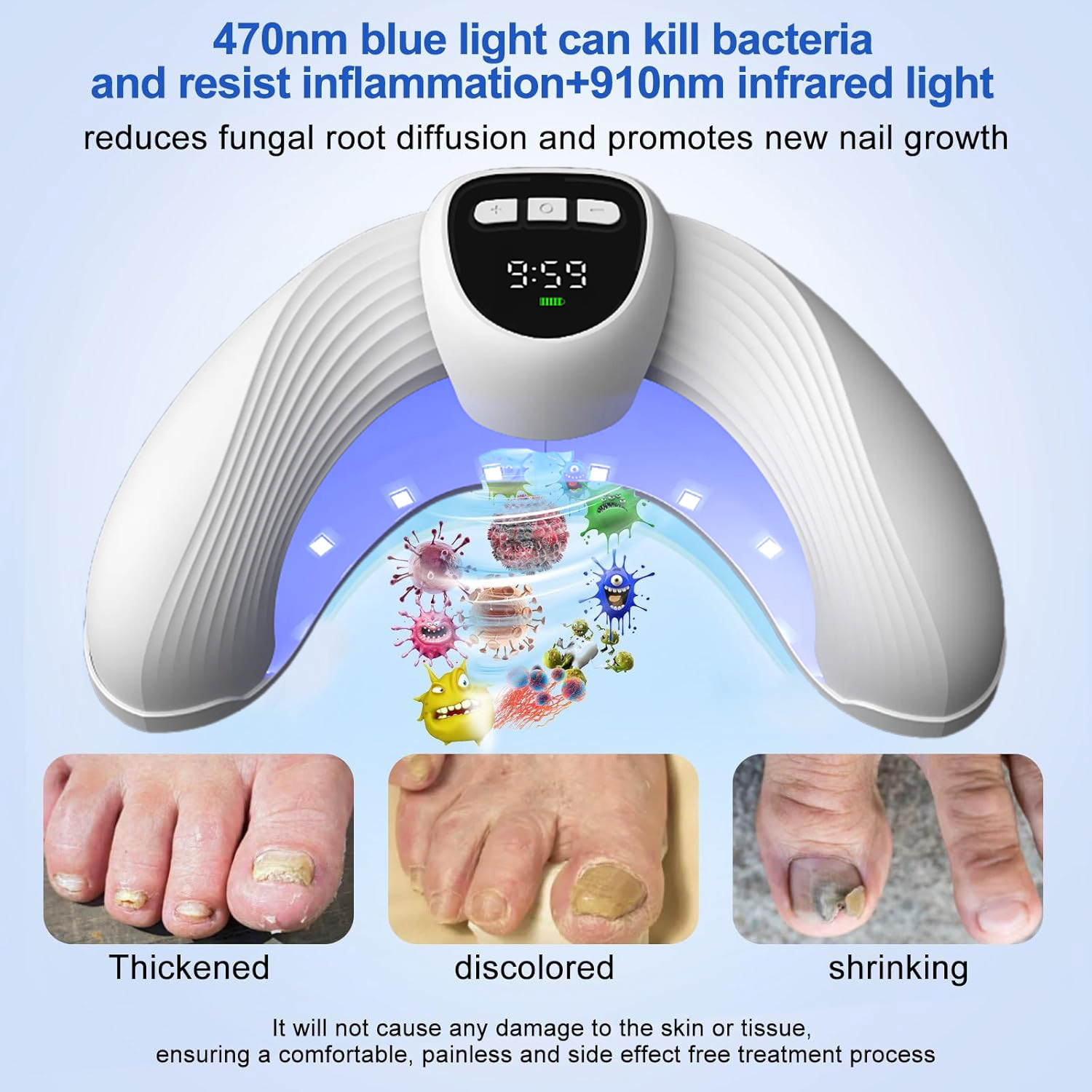 Industrial Laser Removal - Laser Nail Fungus Treatment Device –