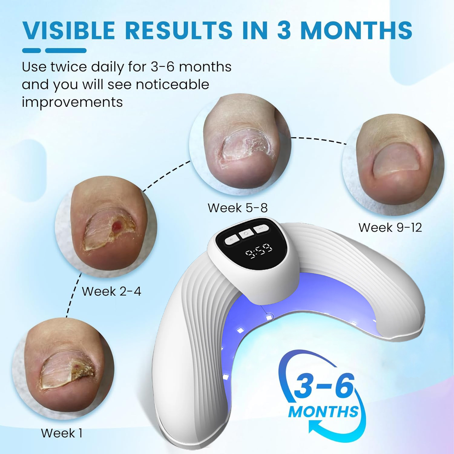 Laser Nail Fungus Treatment De - Industrial Laser Removal 리뷰 및 가격